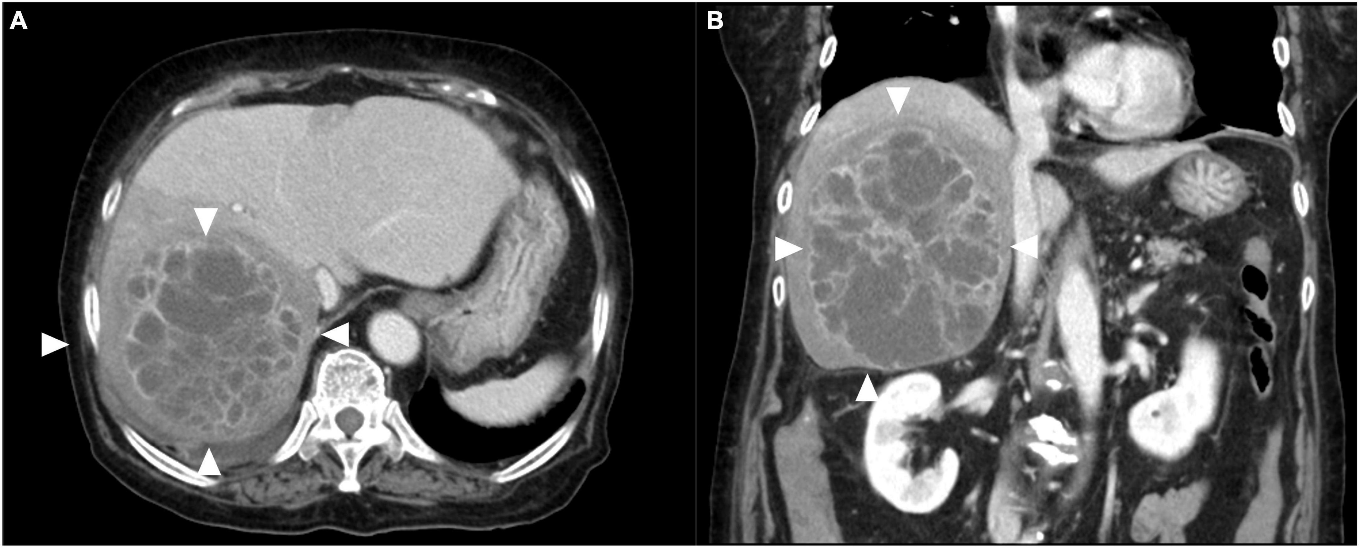 Successful hepatic resection for invasive Klebsiella pneumoniae large multiloculated liver abscesses with percutaneous drainage failure: A case report